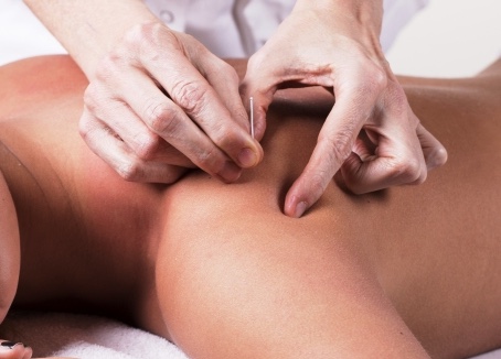 acupuncture